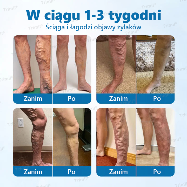 Trimil® Ziołowy Spray na Ochronę Żył – ✅Klinicznie udowodniono, że eliminuje żylaki w zaledwie 7 dni!🌿