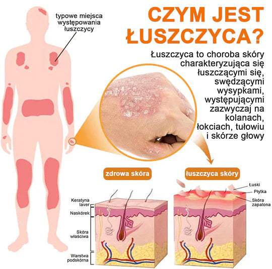 (🔥Płatność przy odbiorze🔥80% zniżki) LOVILDS™ PsoriaHeal Spray na łuszczycę (darmowa wysyłka)