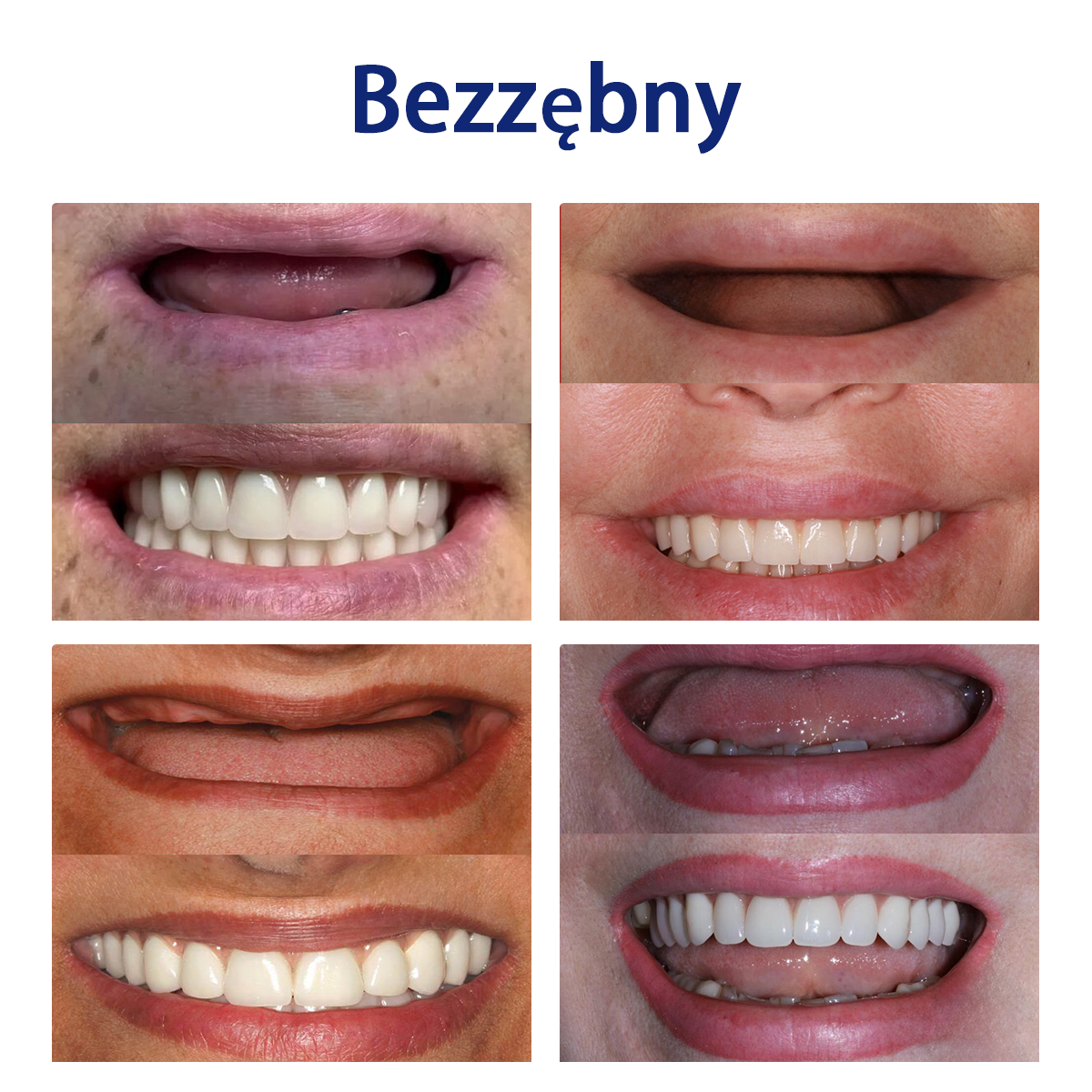Bikenda™ Silikonowy Zestaw Do Mierzenia Protez 🧨🧨 (👩🔬 Zgodny z CED, zatwierdzony przez profesjonalnych dentystów)