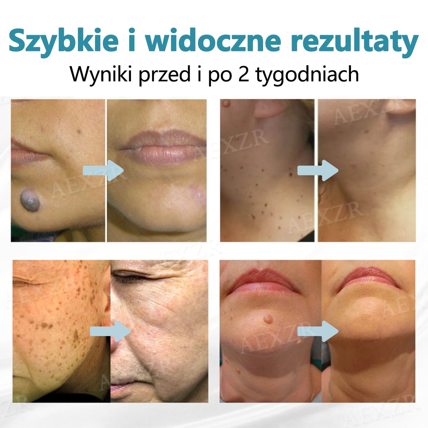 Bikenda® nieinwazyjny laserowy długopis do usuwania znamion i brodawek ✨