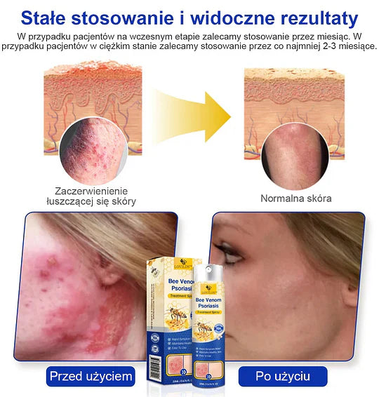 (🔥Płatność przy odbiorze🔥80% zniżki) LOVILDS™ PsoriaHeal Spray na łuszczycę (darmowa wysyłka)