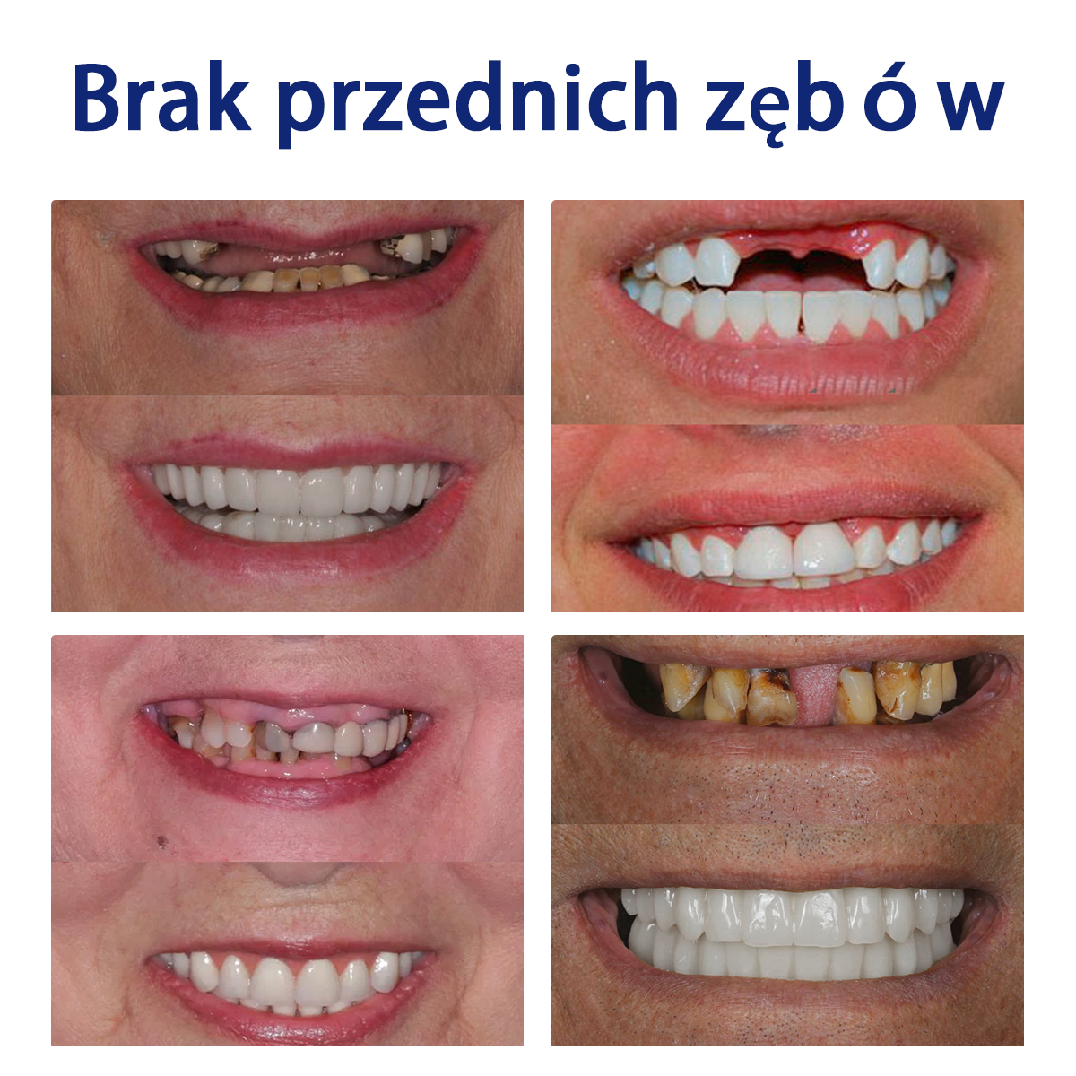 Bikenda™ Silikonowy Zestaw Do Mierzenia Protez 🧨🧨 (👩🔬 Zgodny z CED, zatwierdzony przez profesjonalnych dentystów)