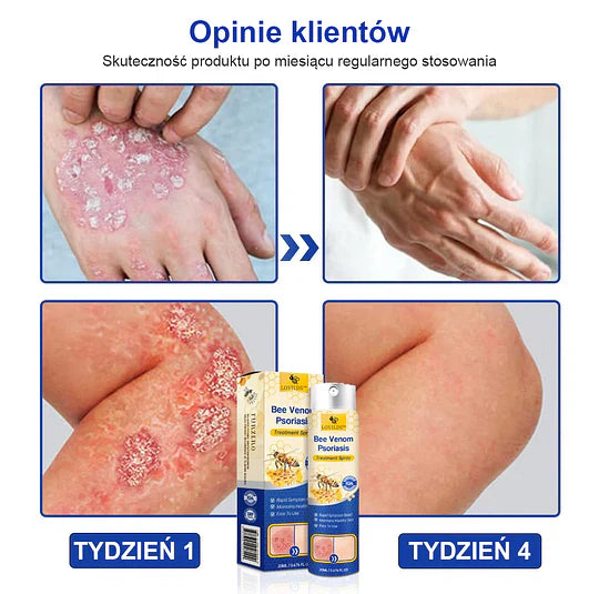 (🔥Płatność przy odbiorze🔥80% zniżki) LOVILDS™ PsoriaHeal Spray na łuszczycę (darmowa wysyłka)