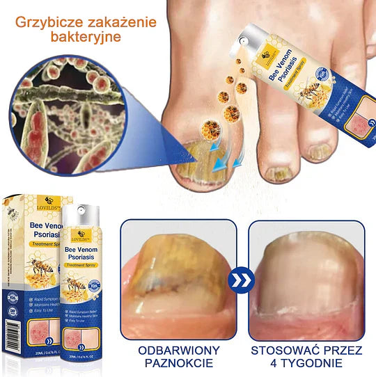 (🔥Płatność przy odbiorze🔥80% zniżki) LOVILDS™ PsoriaHeal Spray na łuszczycę (darmowa wysyłka)