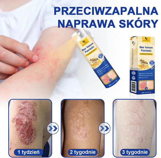(🔥Płatność przy odbiorze🔥80% zniżki) LOVILDS™ PsoriaHeal Spray na łuszczycę (darmowa wysyłka)