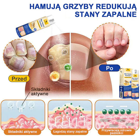 (🔥Płatność przy odbiorze🔥80% zniżki) LOVILDS™ PsoriaHeal Spray na łuszczycę (darmowa wysyłka)