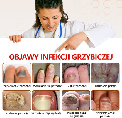 Spray z jadem pszczelim – skuteczny w leczeniu infekcji grzybiczych i zapalenia paznokci🐝