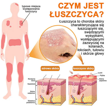 (🔥Płatność przy odbiorze🔥80% zniżki) LOVILDS™ PsoriaHeal Spray na łuszczycę (darmowa wysyłka)