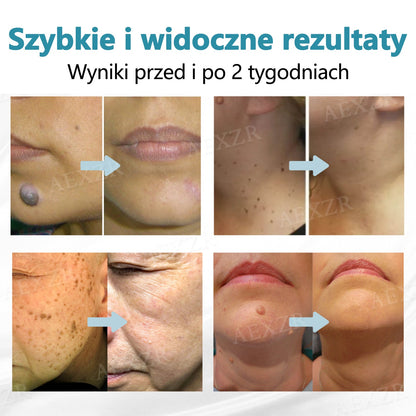 Bikenda® nieinwazyjny laserowy długopis do usuwania znamion i brodawek ✨