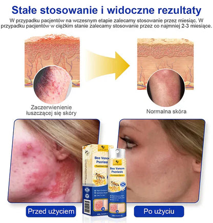(🔥Płatność przy odbiorze🔥80% zniżki) LOVILDS™ PsoriaHeal Spray na łuszczycę (darmowa wysyłka)