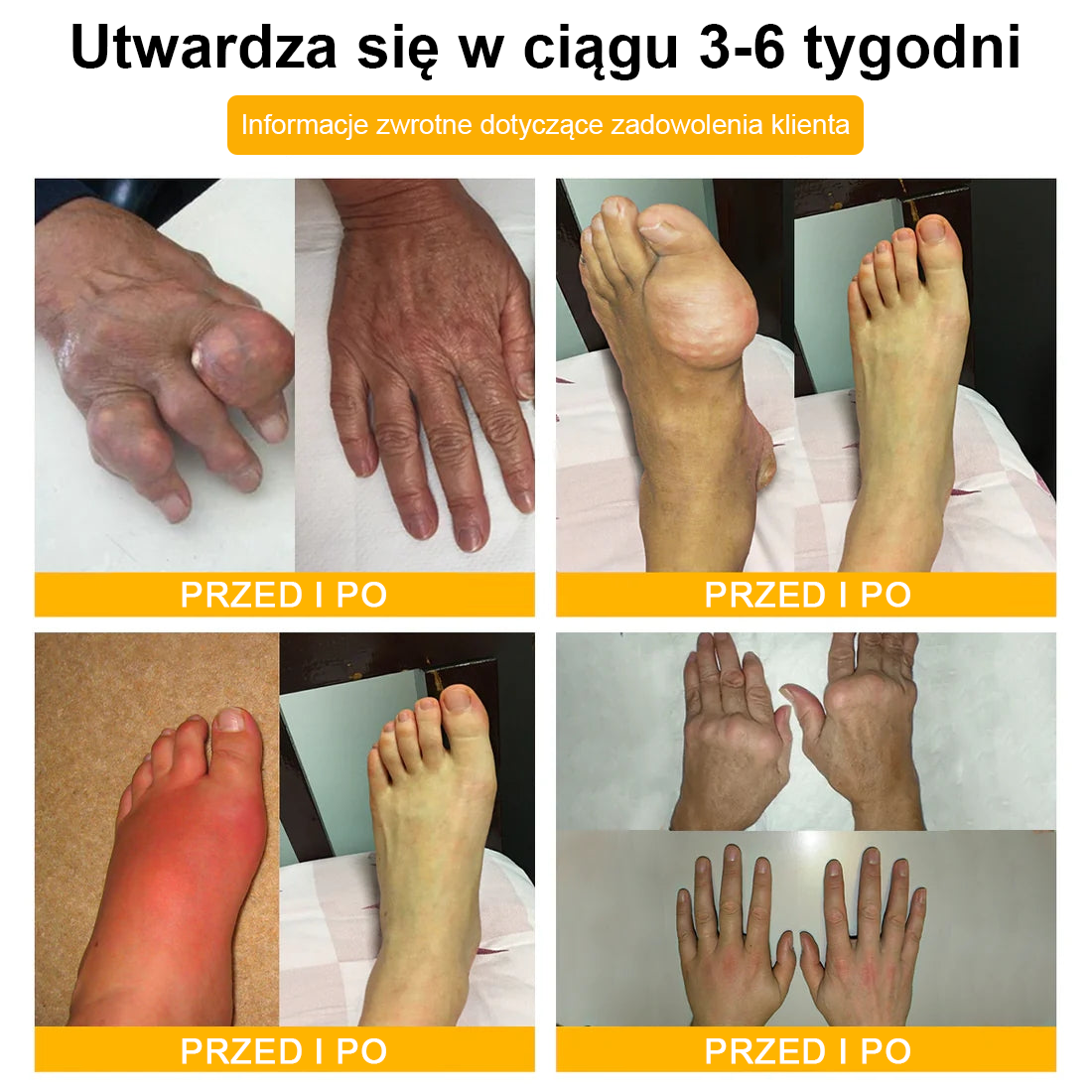 (Specjalnie dla osób starszych & polecane przez ortopedów) 🔥🔥 Krem TLOPA® z Toksyną Botulinową i Jadem Pszczelim – Przeciwbólowy i Regenerujący Kości 🐝🌿