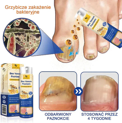 (🔥Płatność przy odbiorze🔥80% zniżki) LOVILDS™ PsoriaHeal Spray na łuszczycę (darmowa wysyłka)